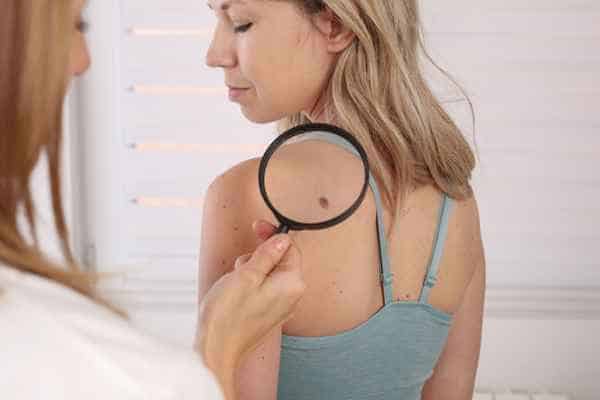 What Are Traditional Skin Lesion Removal Methods St Ives?