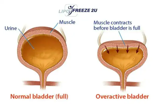diagram of overactive bladder treatment St Ives