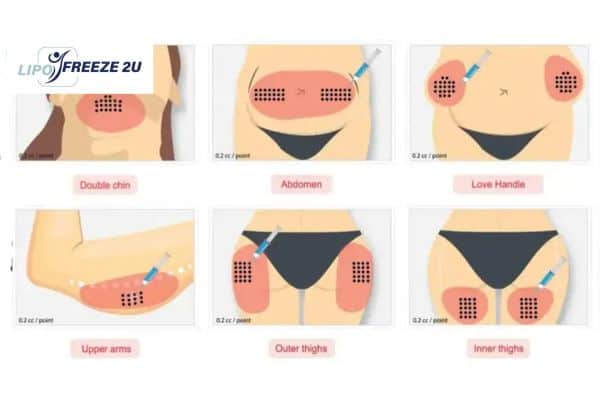 Benefits of Choosing Aqualyx for Fat Reduction St Ives