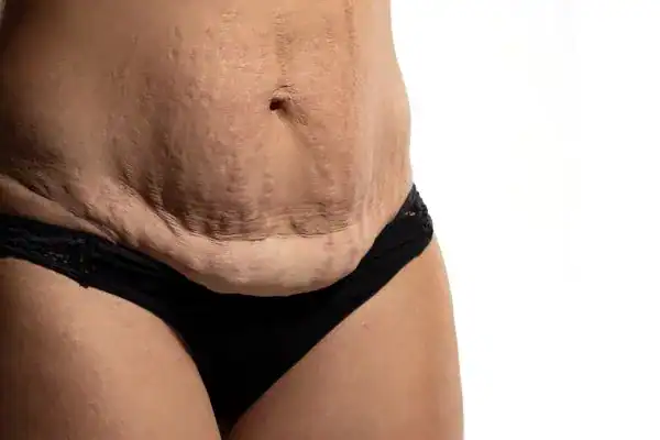 loose skin after weight loss injections St Ives