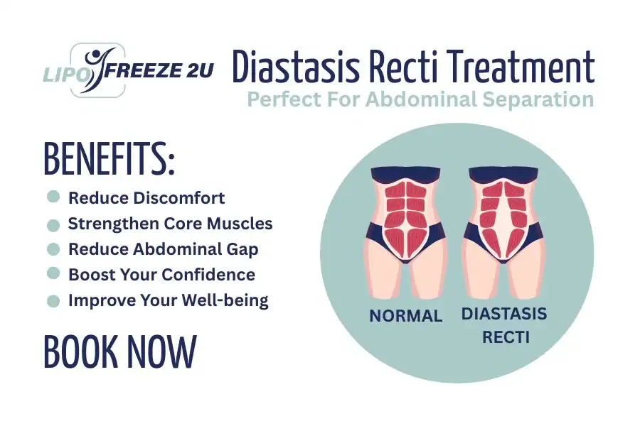 How Long Will It Take to See Improvements in Diastasis Recti St Ives