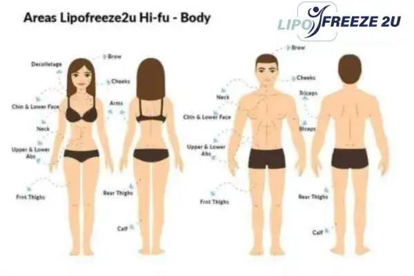 image of areas of the body and HIFU prices St Ives