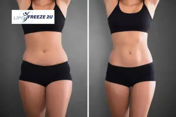 How Can LIPO FREEZE 2U Support Your Post-Pregnancy Body Recovery St Ives?