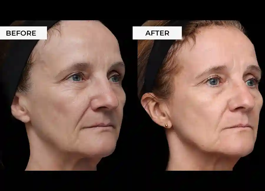 How Many RF Microneedling Sessions Will You Need to See a Difference St Ives?