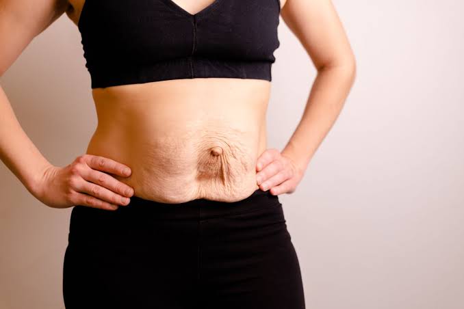 Is Surgery Really the Only Way to Repair Diastasis Recti St Ives?