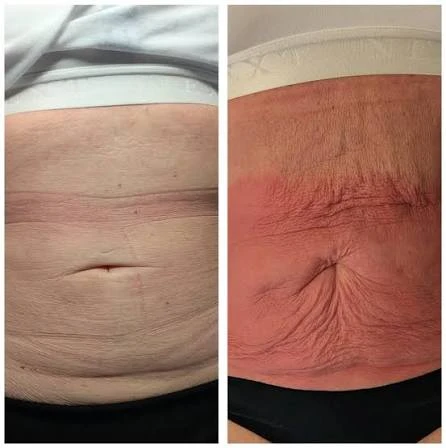 How Does RF Microneedling Improve Crepey, Thin and Uneven Skin Texture St Ives?