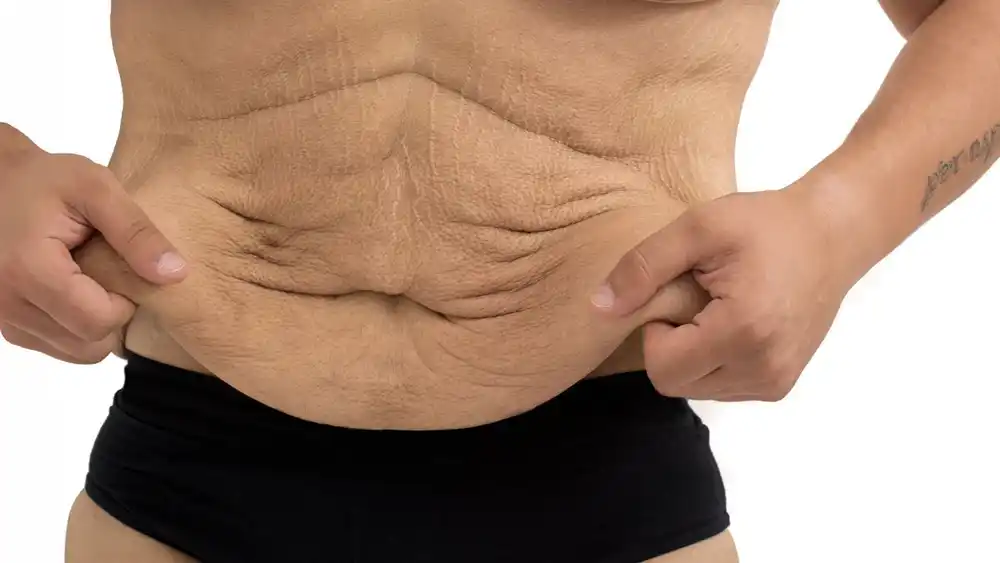 Why Does Weight Loss Medication Leave Some People With Loose or Sagging Skin St Ives?